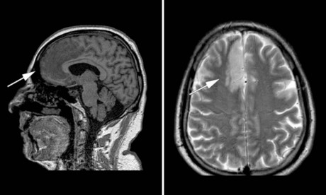 Man Suffered A Stroke That Made Him Believe It Was Fine To Masturbate In Front Of His Relatives Mail